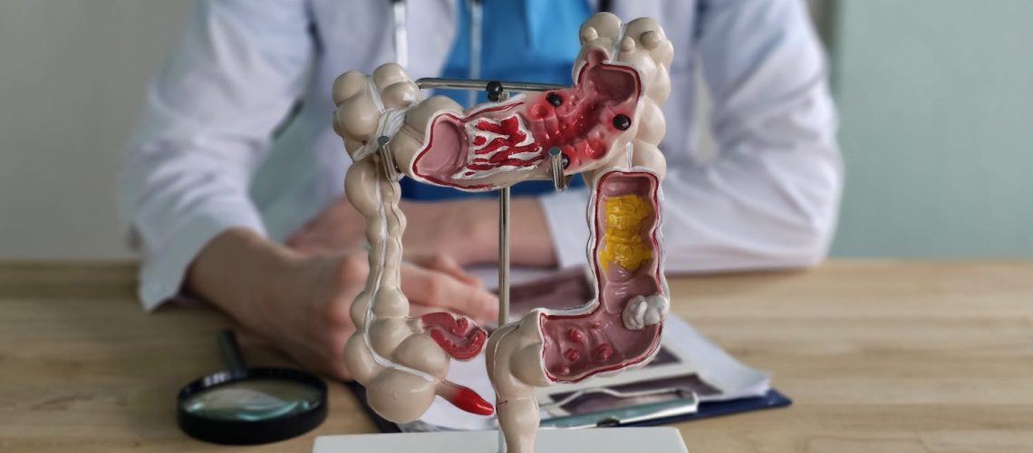 Symptômes : comment commence un cancer du côlon ?